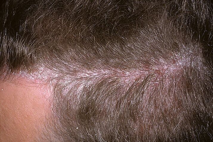 Psoriasis of the head