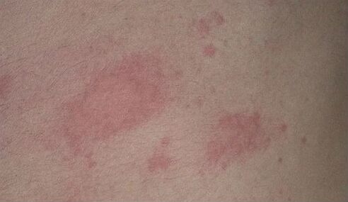 red spots in psoriasis