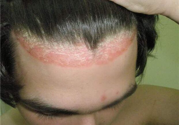 crown psoriasis on the head