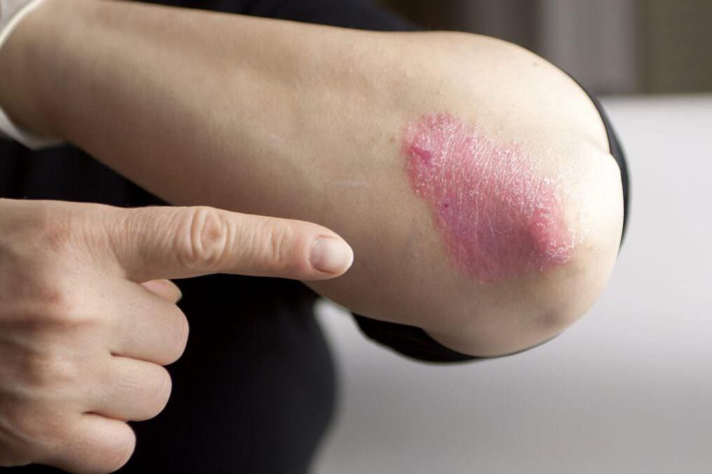 Manifestations of the initial phase of elbow psoriasis