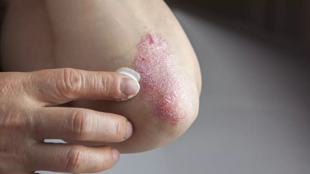 Psoriatic plaques on the elbow treated with medical cream