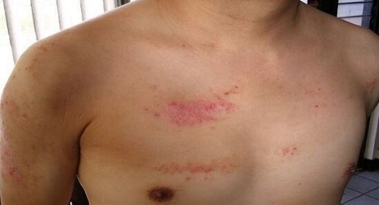 Breast psoriasis