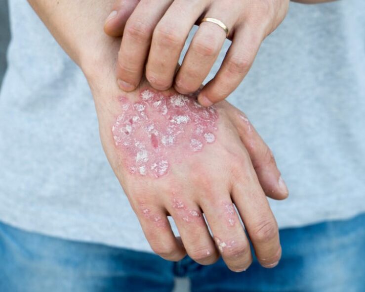Psoriasis in arms