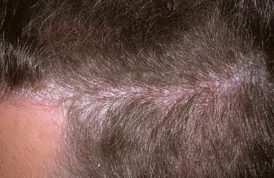 Psoriasis on the head