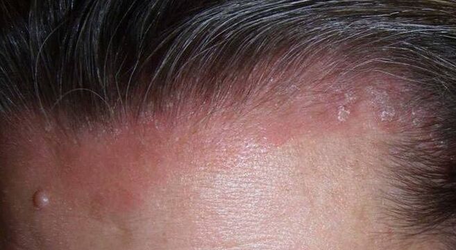 What is psoriasis