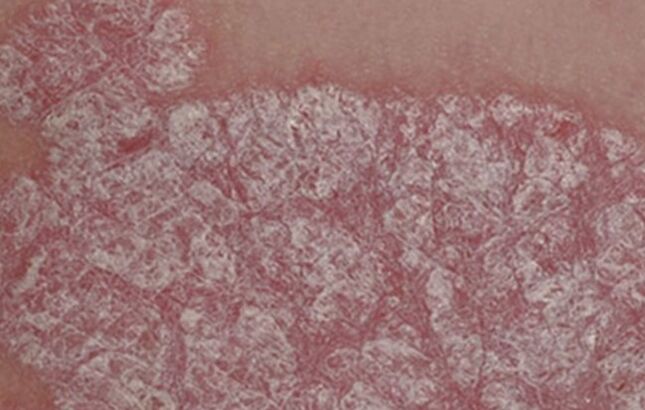 Papule healing
