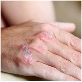 Brush psoriasis