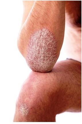 Psoriasis on an elbow