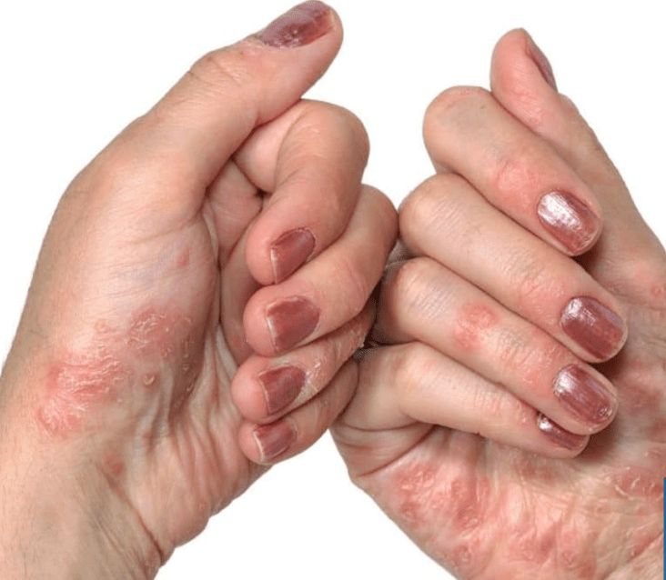 Psoriasis in arms