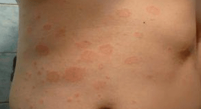 Neucky Psoriasis