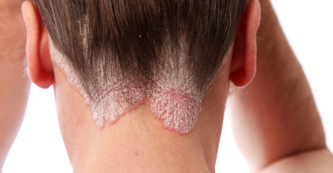 Psoriasis at the head of a girl