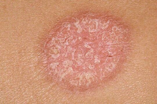 psoriasis