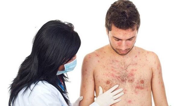 Psoriaasis photo