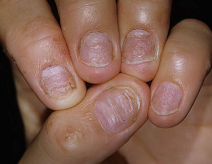 Psoriasis nail