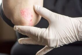 Psoriasis on an elbow