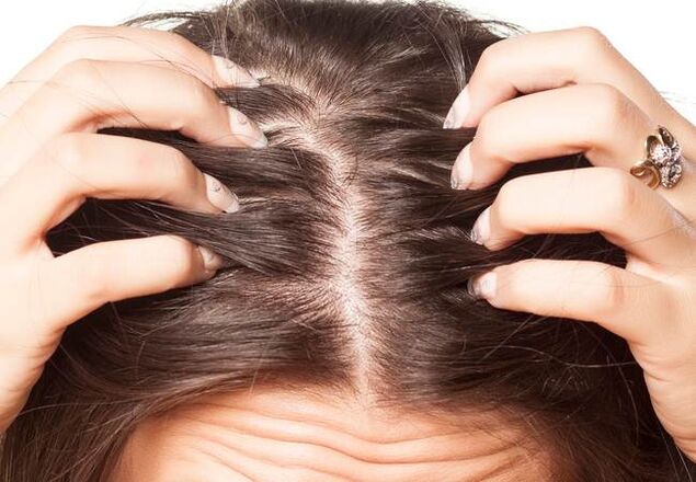 Psoriasis on the head