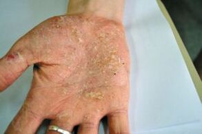 Psoriasis on the palm of your hand