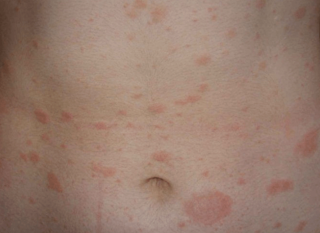 Regressive stage of psoriasis