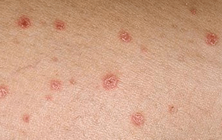 Psoriasis in the very initial stage