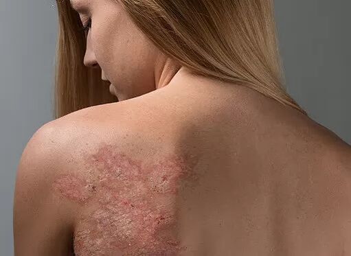 Psoriasis on the girl's back