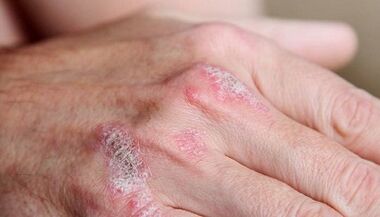 symptoms of the initial stage of psoriasis