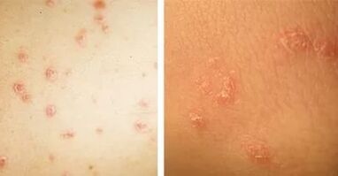 main manifestations of psoriasis