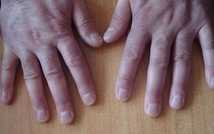 symptoms of psoriasis in the initial stage