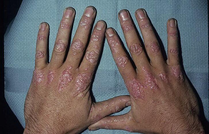 reasons for the development of psoriasis on the hands