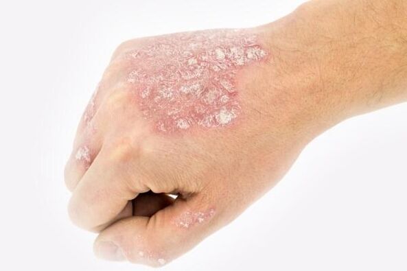 the mechanism of development of psoriasis on the hands