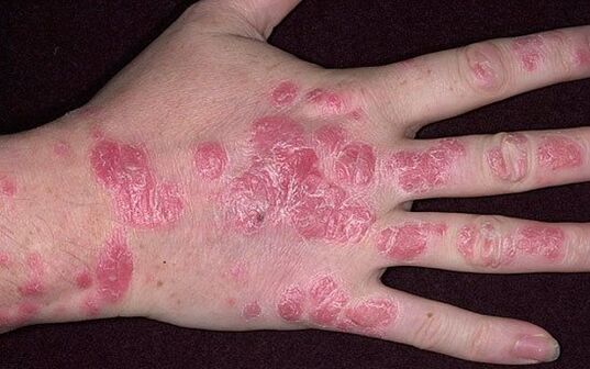 psoriasis plaque on the hands
