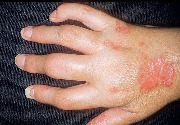 psoriatic arthritis of the hands