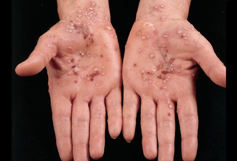 what psoriasis on the palms looks like