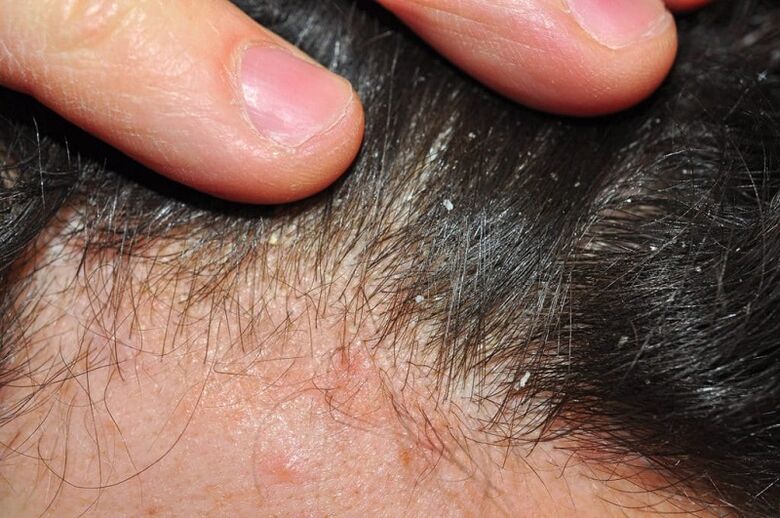 symptoms of psoriasis of the head