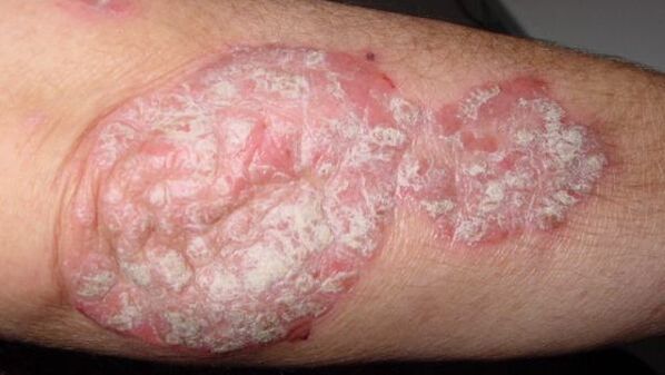 Old psoriasis