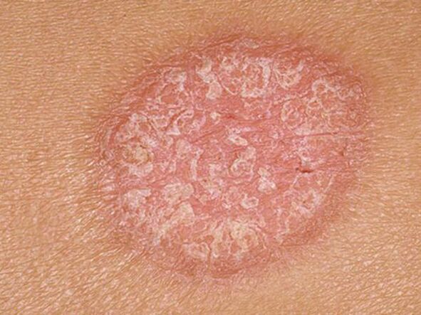 Stationary stage papules