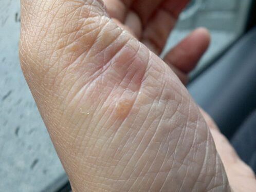 photo of psoriasis on hand