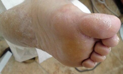 Psoriasis of the foot