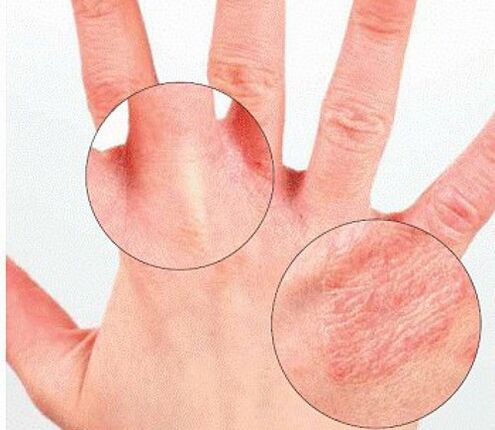 Psoriatic redness and peeling on the hands