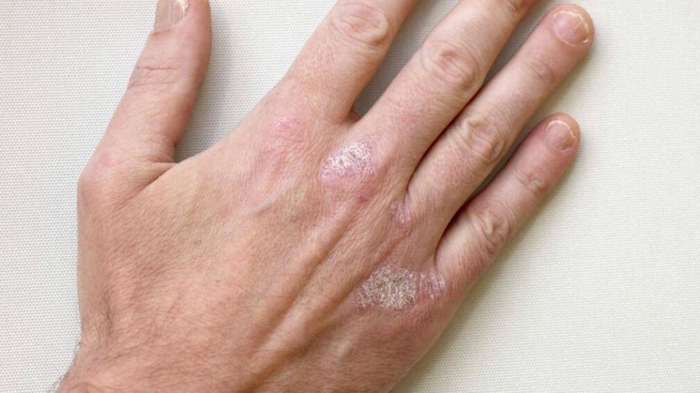 Psoriasis on the hands