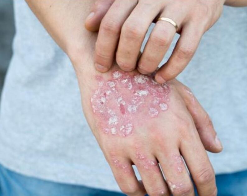 psoriasis on the hands of a man