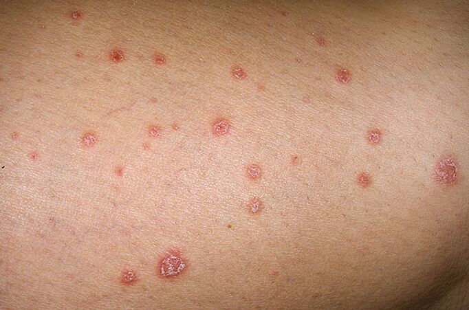 photographs of the first symptoms of psoriasis