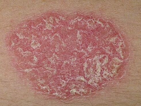 what psoriasis looks like