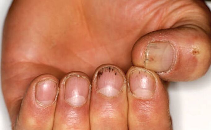 Bleeding under the nails in psoriasis