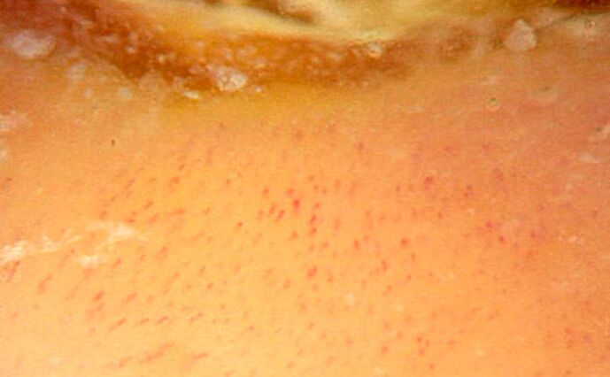 Dermatoscopy with a magnification of 40 times which confirms psoriasis