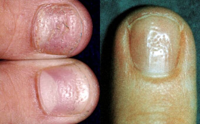 Finger symptom - multiple indentations on the surface of the nail plate