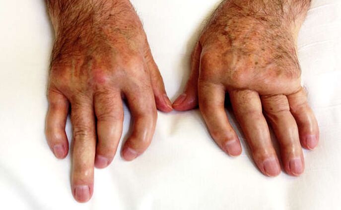 Mutilative arthritis in psoriasis