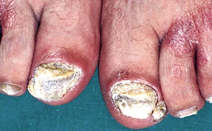 Severe subungual hyperkeratosis and psoriatic plaques on the fingers