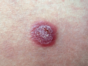 a symptom of a psoriasis rash in the form of a tear