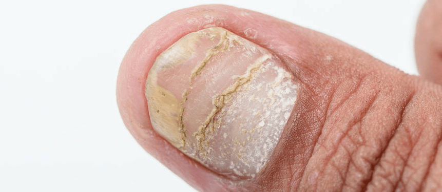 acute form complication of psoriasis of the nail