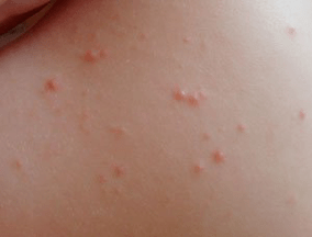 precise symptom of psoriasis rash